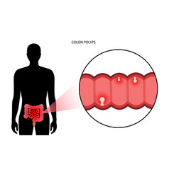 Colon Polyps Inflammation