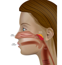 Adenoids Pharyngeal Tonsil Or Nasopharyngeal