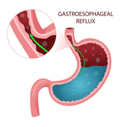 Gastroesophageal Reflux Disease Diagram