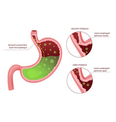 Gastroesophageal Reflux Disease Diagram