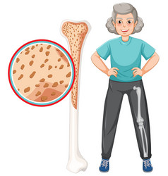 Osteoporosis In Old People