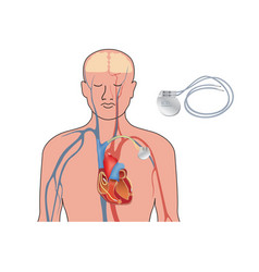 Heart Pacemaker In Work Human Artificial