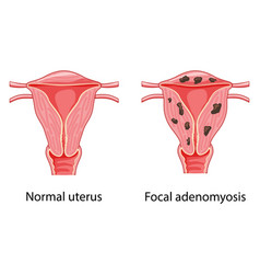 Adenomyosis Focal Human Anatomy Female