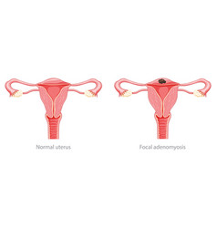 Focal Adenomyosis Human Anatomy Female Sick