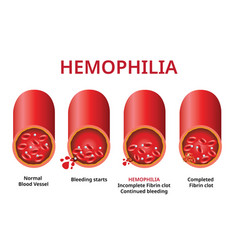 Hemophilia Damaged Blood Vessel Haemophilia