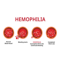 Hemophilia Damaged Blood Vessel Haemophilia