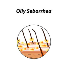 Oily Seborrhea Of Skin And Hair Dandruff