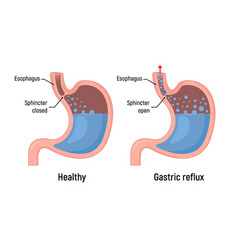 Esophageal Gastric Reflux Acid Indigestion