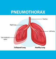 Pneumothorax diagram of human anatomy Royalty Free Vector