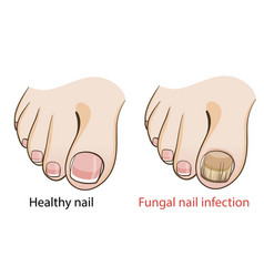 Nail Fungal Infection