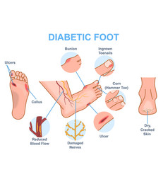 Diabetic Foot Medical Diagram