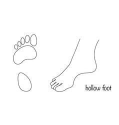 Footprint And Hollow Foot