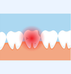 Dead Tooth Hurting And Giving A Red Pain Signal