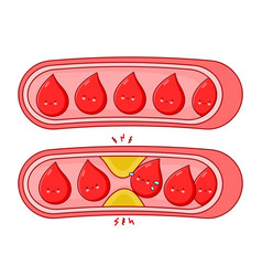 Normal And Clogged Blood Vessels