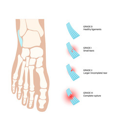 Sprained Ankle Injury