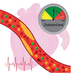 Atherosclerotic Plaque In Blood Vessel Good