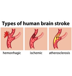 Types Of Human Brain Stroke