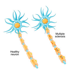 Multiple Sclerosis Autoimmune Disease