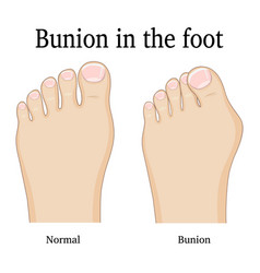 Bunion In The Foot