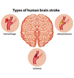 Types Of Human Brain Stroke