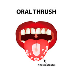 Oral Thrush Candidiasis On The Tongue Fungus