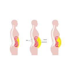 Visceral Fat Diagram