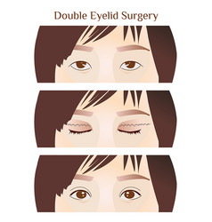 Step Narrow-eyed To Double Eyelid Surgery