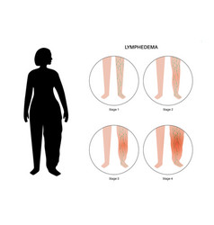 Stages Of Lymphedema