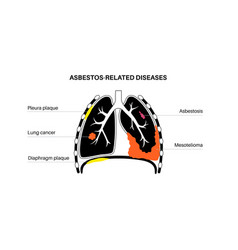 Asbestos Related Diseases