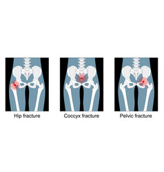 Hip Fracture Break Of The Sacrum Or Pelvis Pain