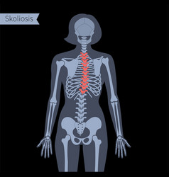 Spine X Ray