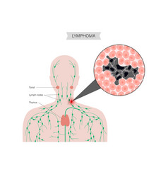 Lymphoma Cancer Concept