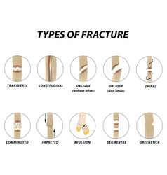 Types Of Fracture Fracture Bone Set Infographics