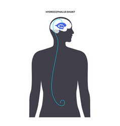 Hydrocephalus Shunt Concept