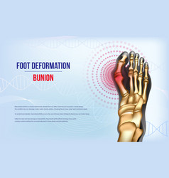 Foot Deformation Bunion