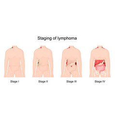 Lymphoma Stage Cancer Of The Lymphatic System