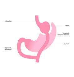 Gastric Bypass Surgery