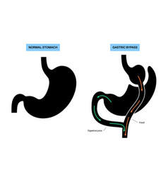 Gastric Bypass Surgery