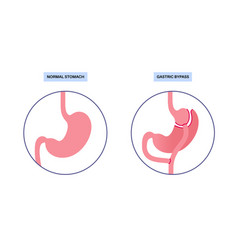 Gastric Bypass Surgery