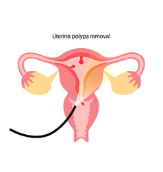 Uterus Polyps