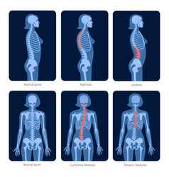 Spine X Ray