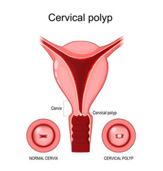 Cervical Polyp Normal Cervix And Benign Tumor