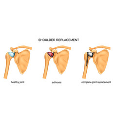 Shoulder Replacement Surgery