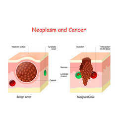 Cancer And Neoplasm Comparison And Difference