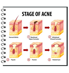 Stages Skin Acne Anatomy