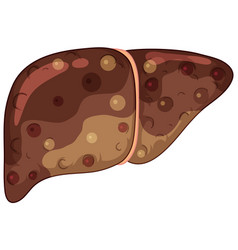 Fibrosis Liver On White Background