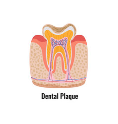 Dental Plaque Poster