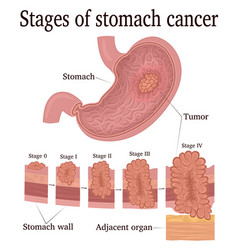 Stages Of Stomach Cancer