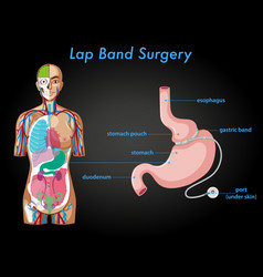 Lap Band Surgery Anatomy