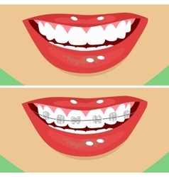 Dental Braces Before And After